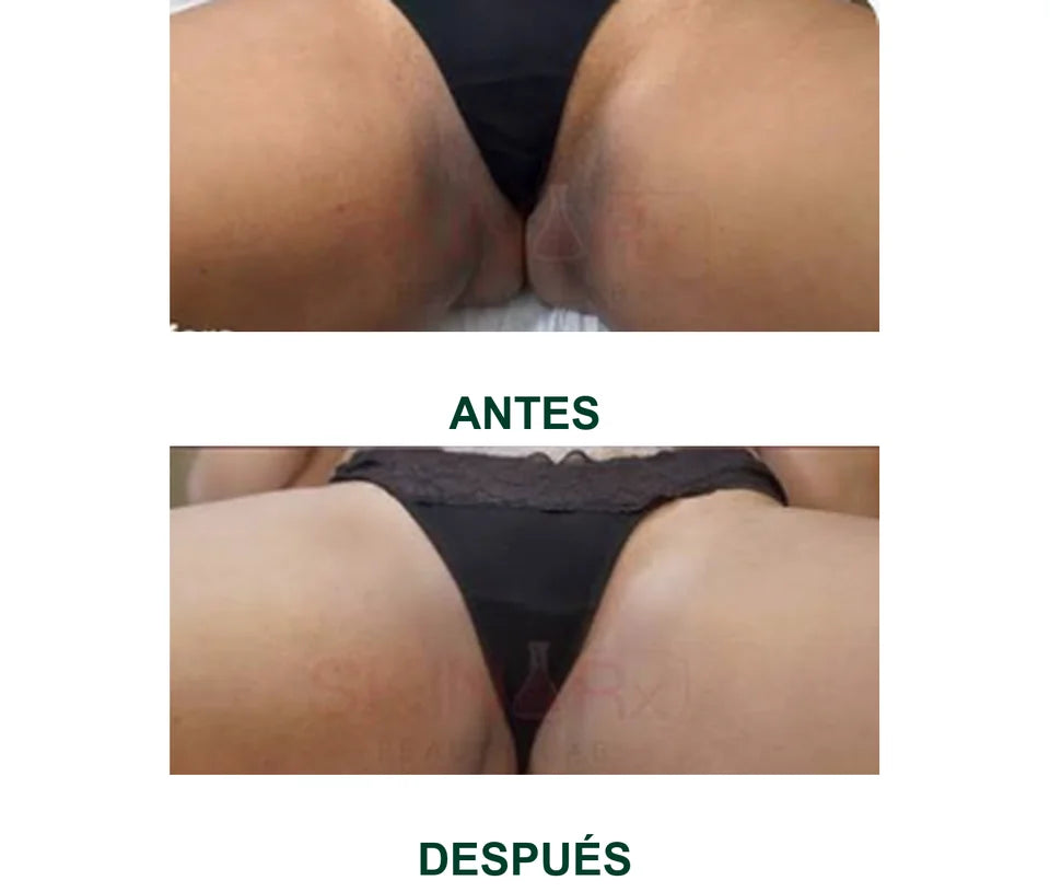 Comparación ilustrativa de la piel de la cadera